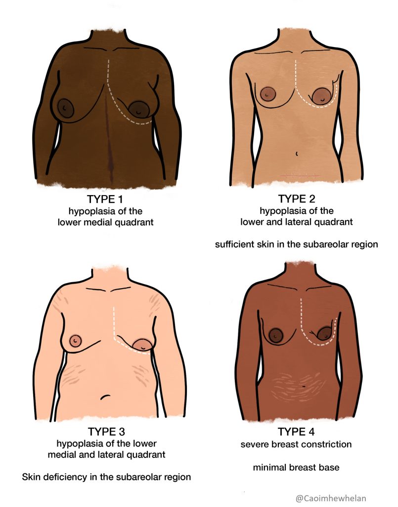 Understanding Tubular Breasts